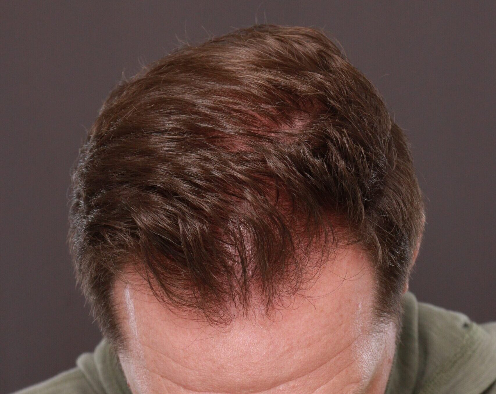 After Image: FUT Hair Transplant by Dr. Thompson - front