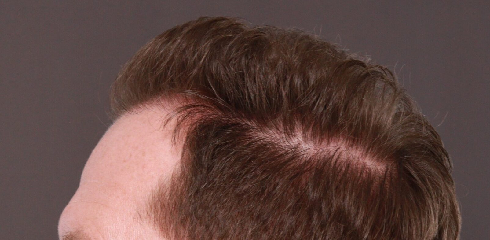 After Image: FUT Hair Transplant by Dr. Thompson - left-side