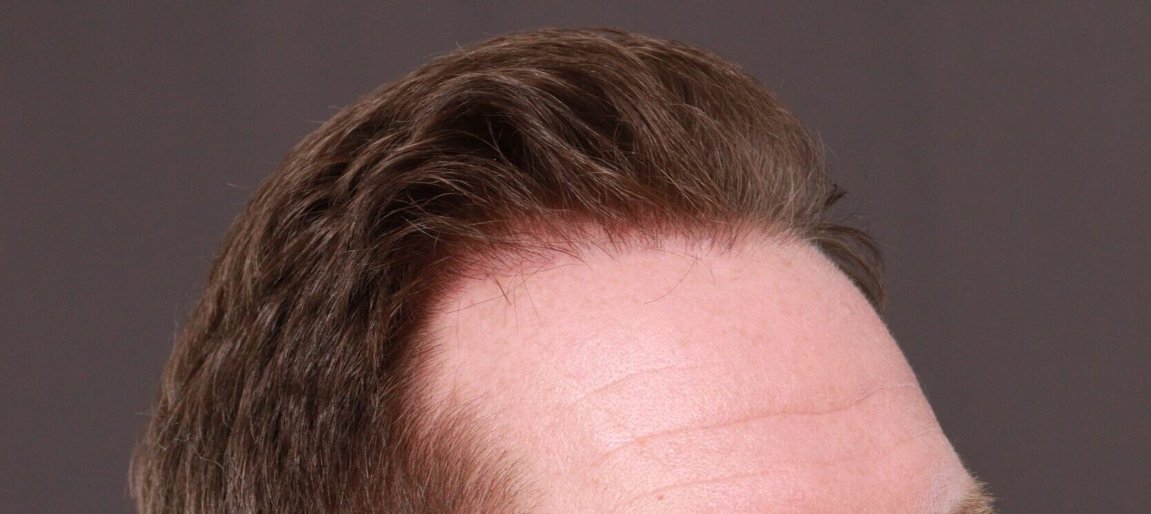 After Image: FUT Hair Transplant by Dr. Thompson - right-front-oblique