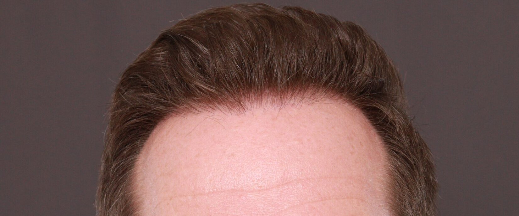 After Image: FUT Hair Transplant by Dr. Thompson - front