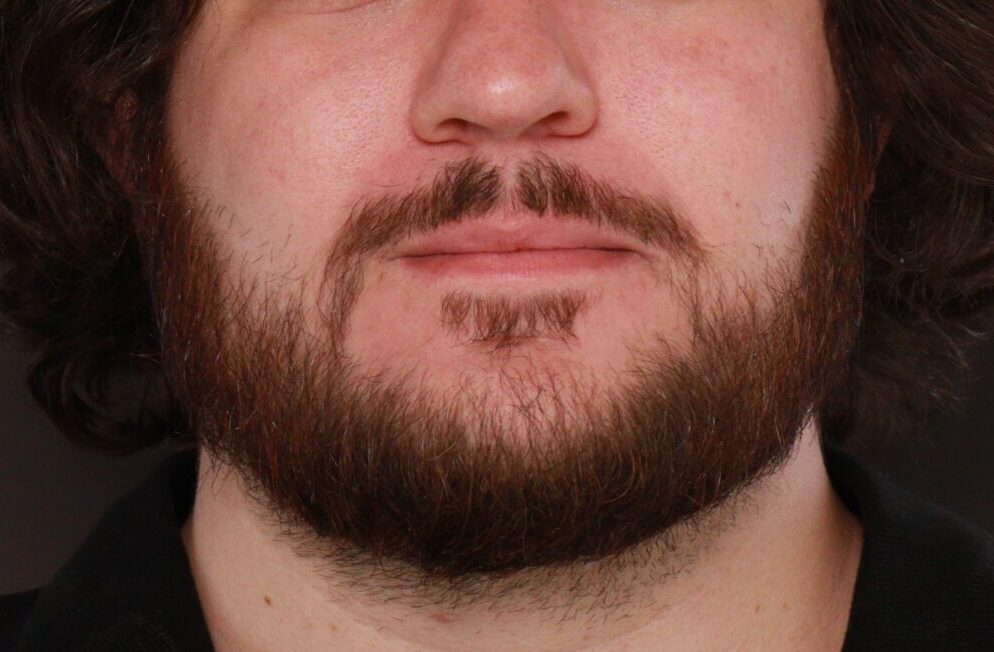 Before Image: Mustache and Beard Transplant by Dr. Manning - front