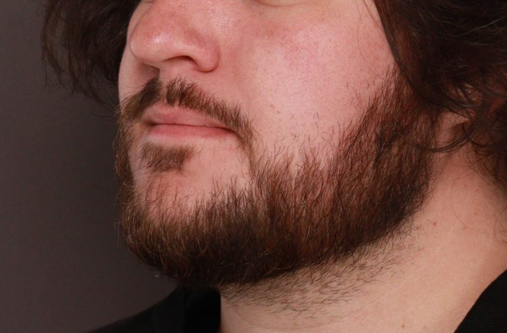 Before Image: Mustache and Beard Transplant by Dr. Manning - left-front-oblique