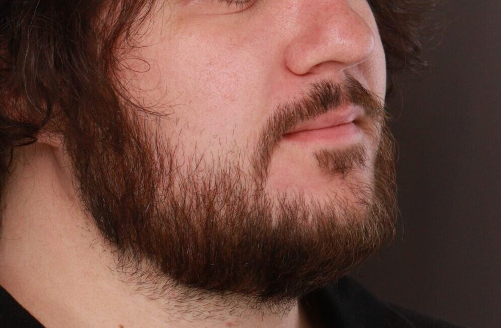 Before Image: Mustache and Beard Transplant by Dr. Manning - right-front-oblique