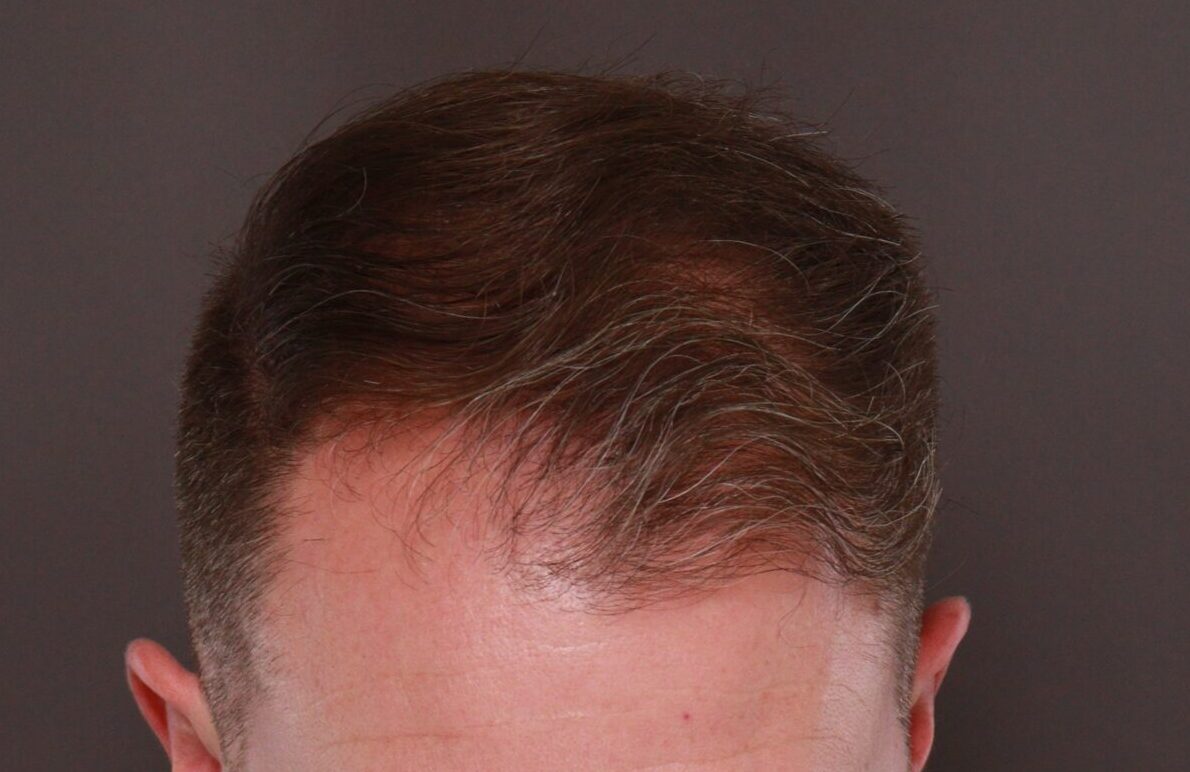 Before Image: FUE Hair Transplant by Dr. Manning - front