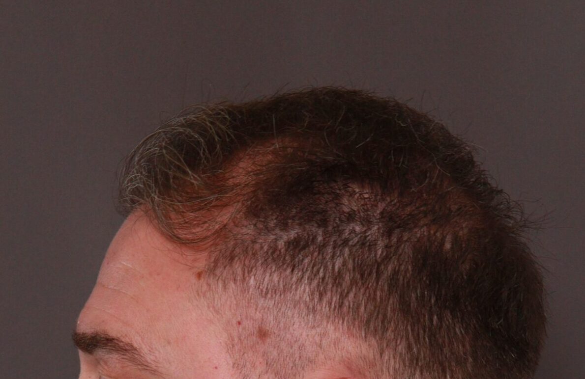 Before Image: FUE Hair Transplant by Dr. Manning - right-side