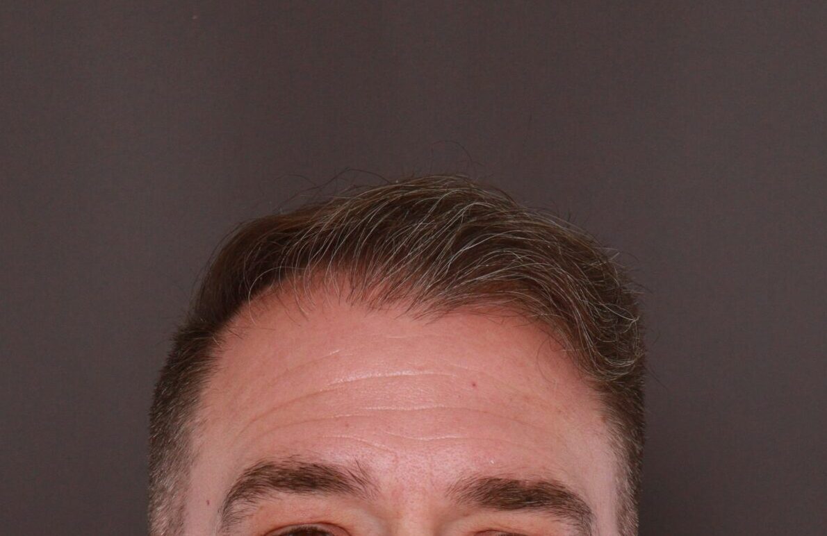 Before Image: FUE Hair Transplant by Dr. Manning - front