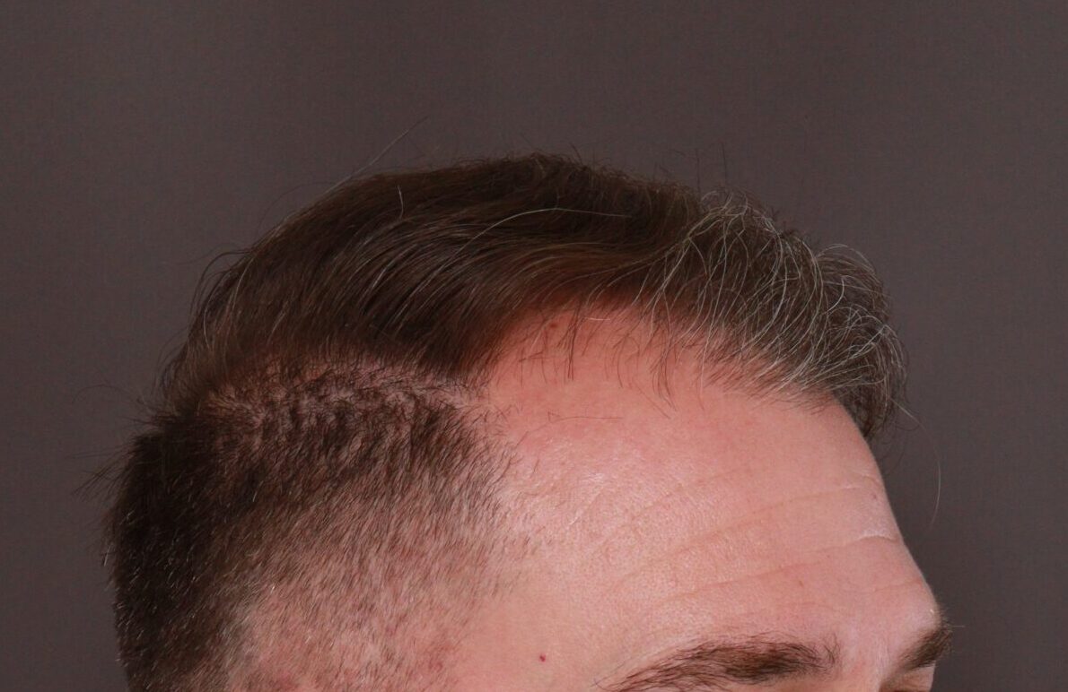 Before Image: FUE Hair Transplant by Dr. Manning - left-front-oblique