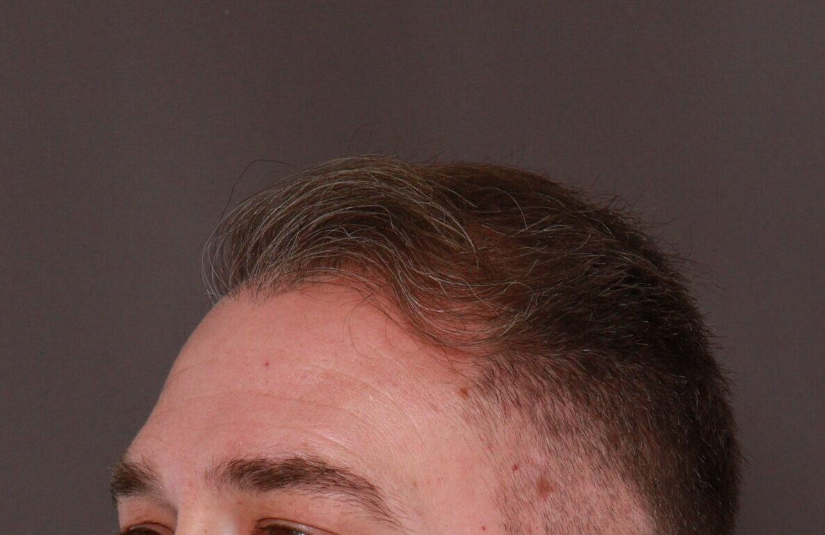 Before Image: FUE Hair Transplant by Dr. Manning - right-front-oblique