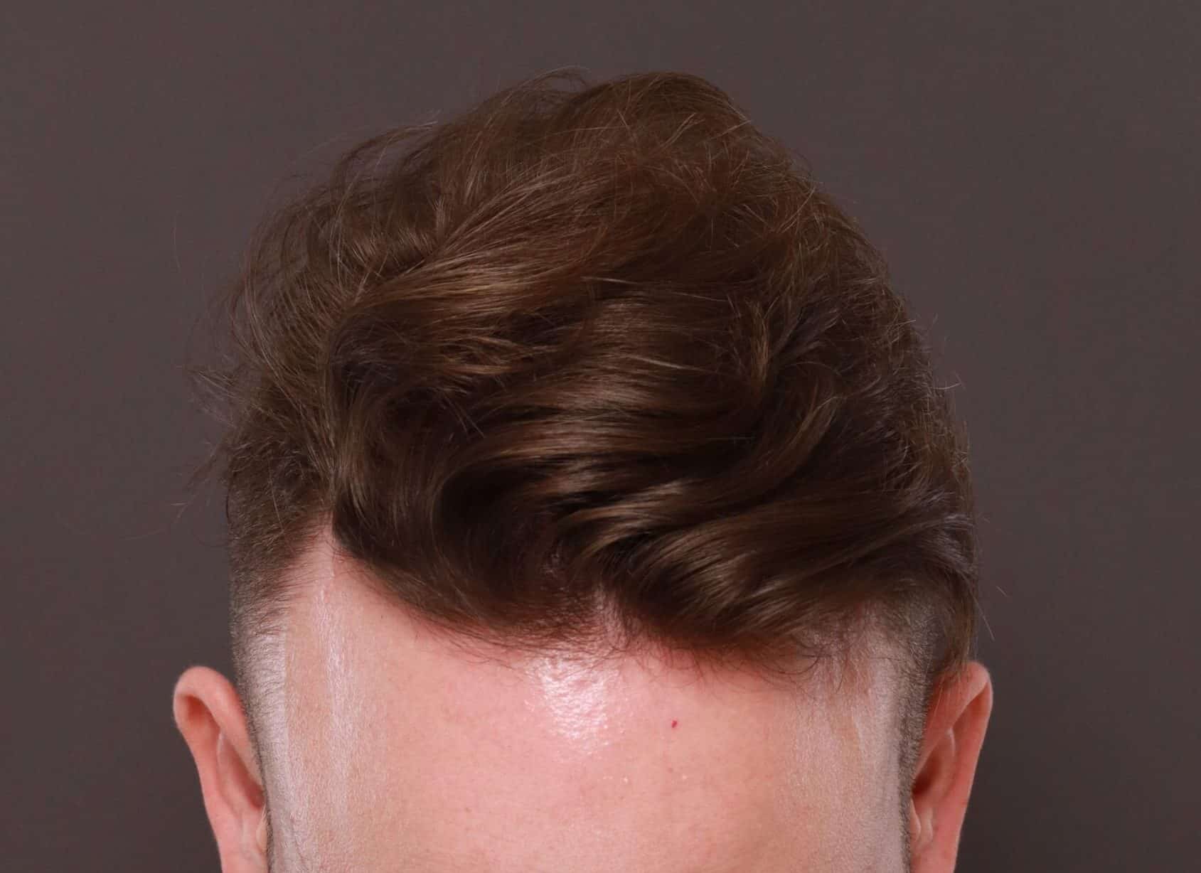 Before Image: FUE Hair Transplant by Dr. Thompson - front