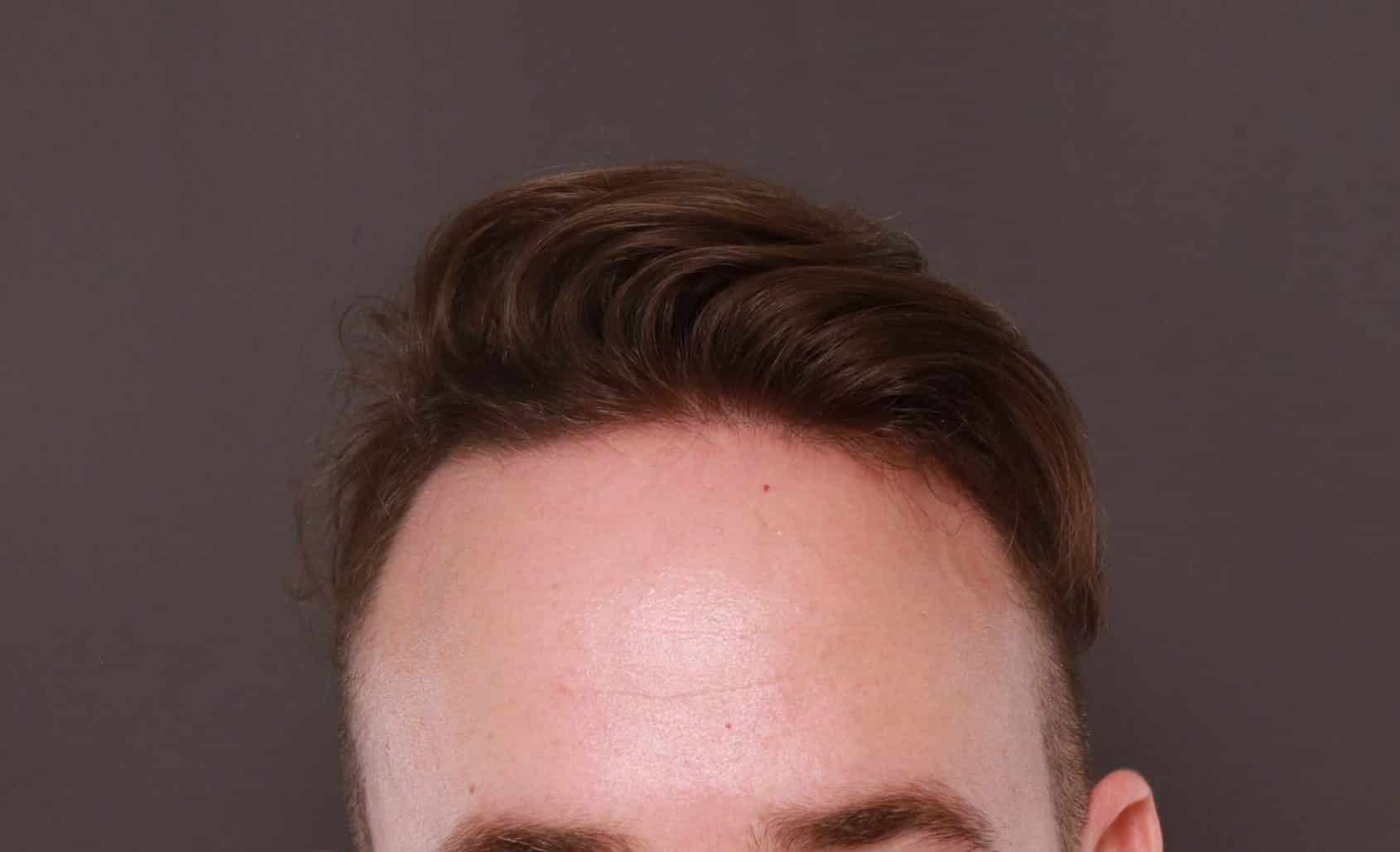Before Image: FUE Hair Transplant by Dr. Thompson - front