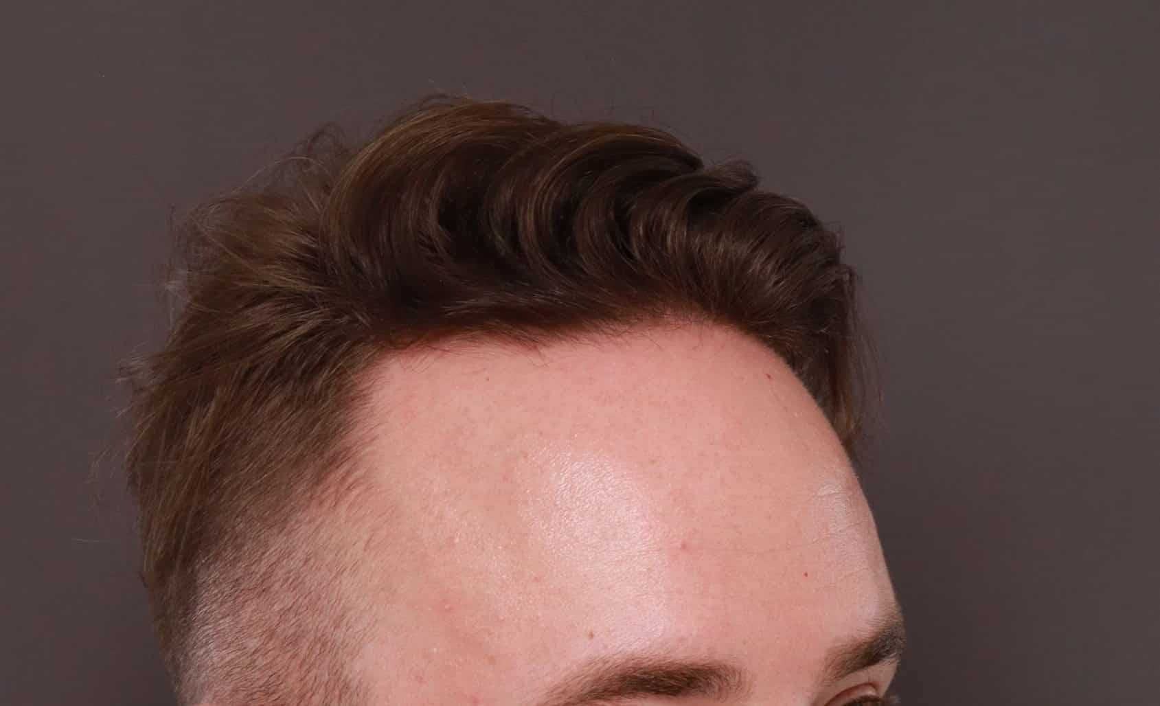 Before Image: FUE Hair Transplant by Dr. Thompson - right-front-oblique