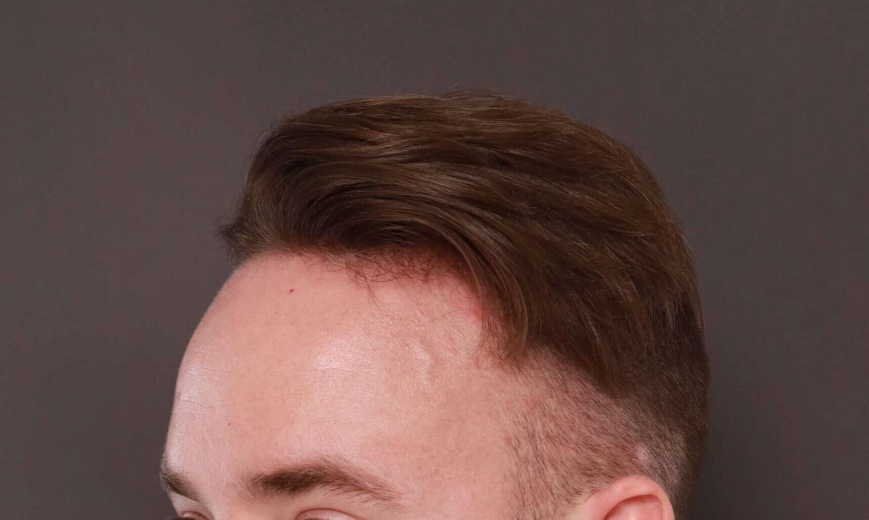 Before Image: FUE Hair Transplant by Dr. Thompson - left-front-oblique