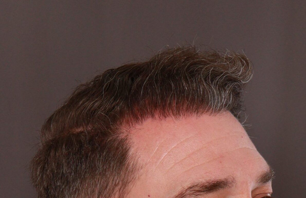 After Image: FUE Hair Transplant by Dr. Manning - left-front-oblique