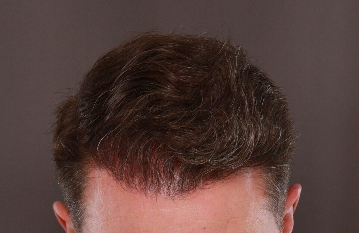 After Image: FUE Hair Transplant by Dr. Manning - front