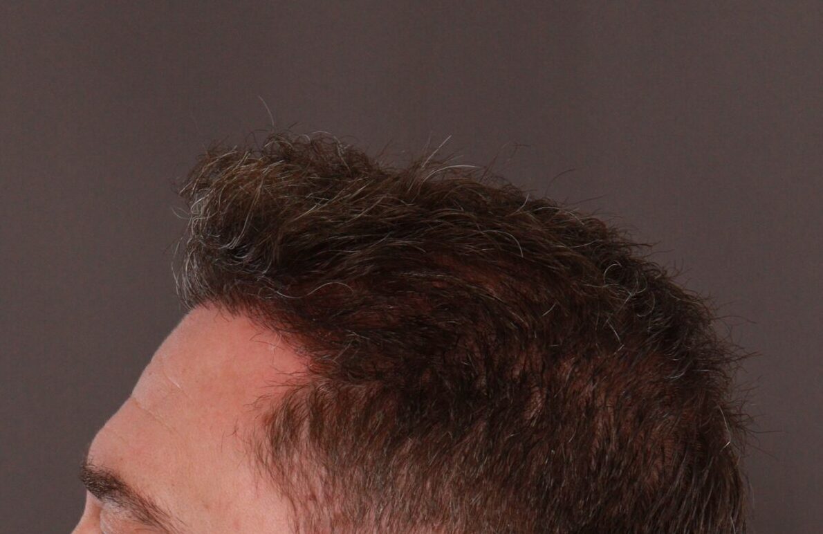 After Image: FUE Hair Transplant by Dr. Manning - right-side