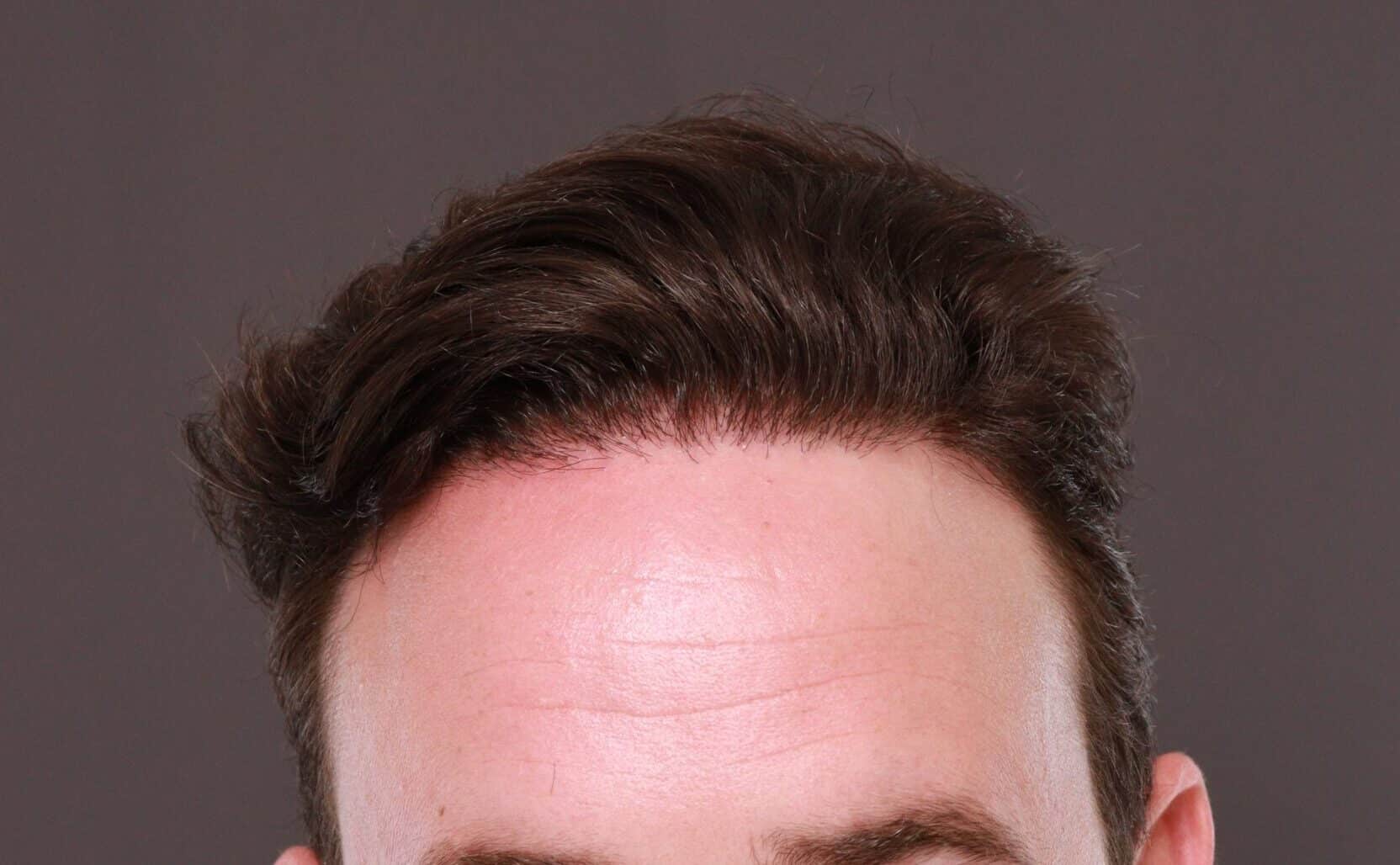 After Image: FUE Hair Transplant by Dr. Thompson - front