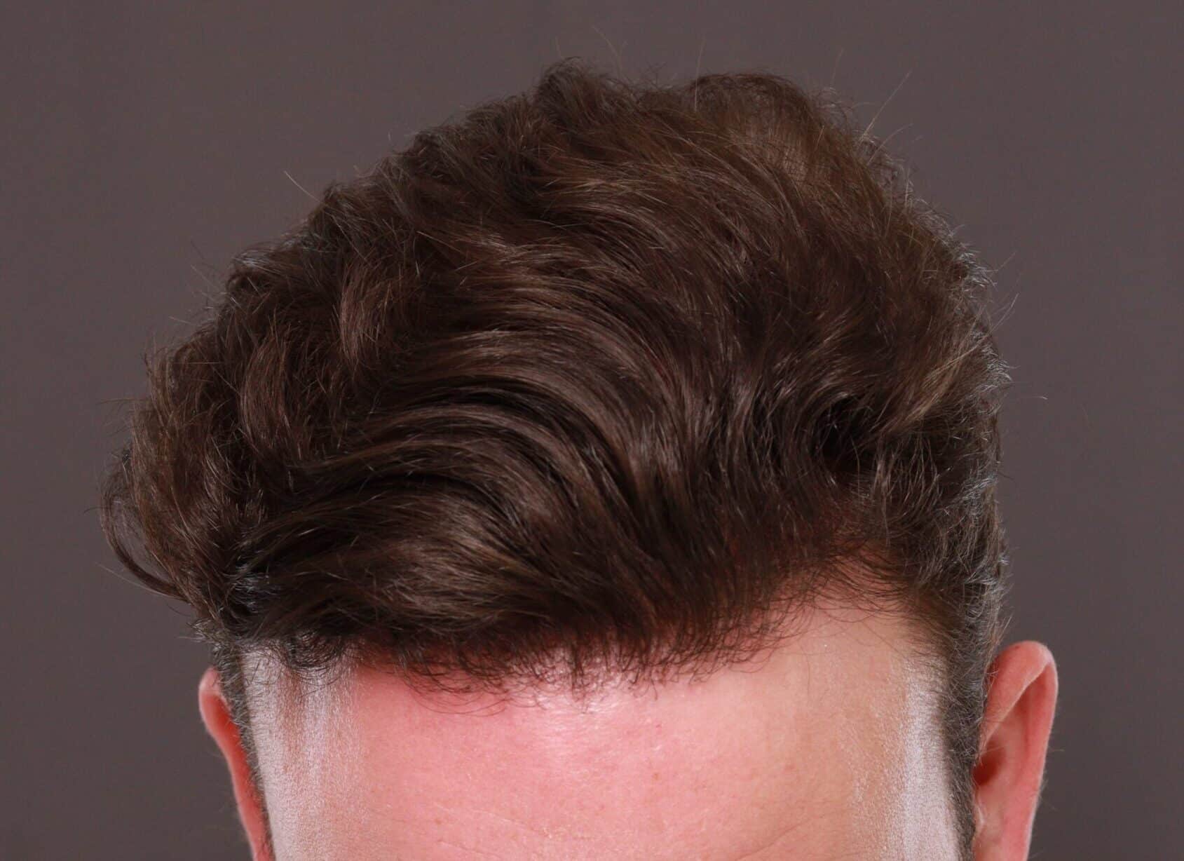 After Image: FUE Hair Transplant by Dr. Thompson - front