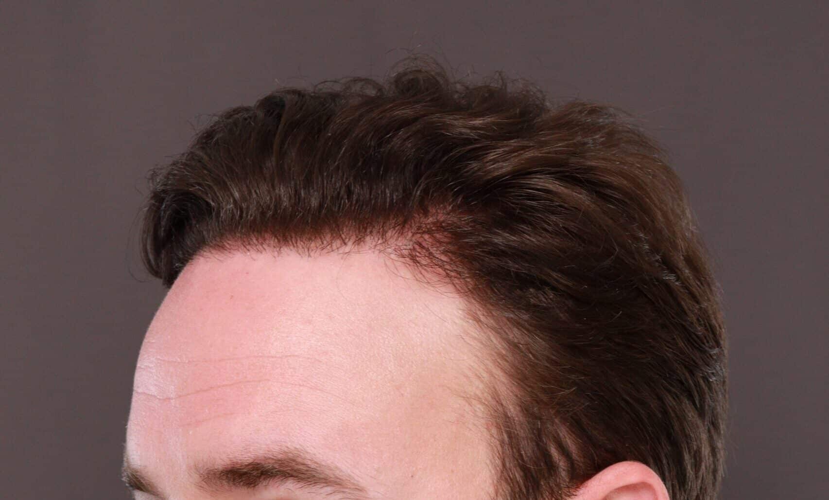 After Image: FUE Hair Transplant by Dr. Thompson - left-front-oblique