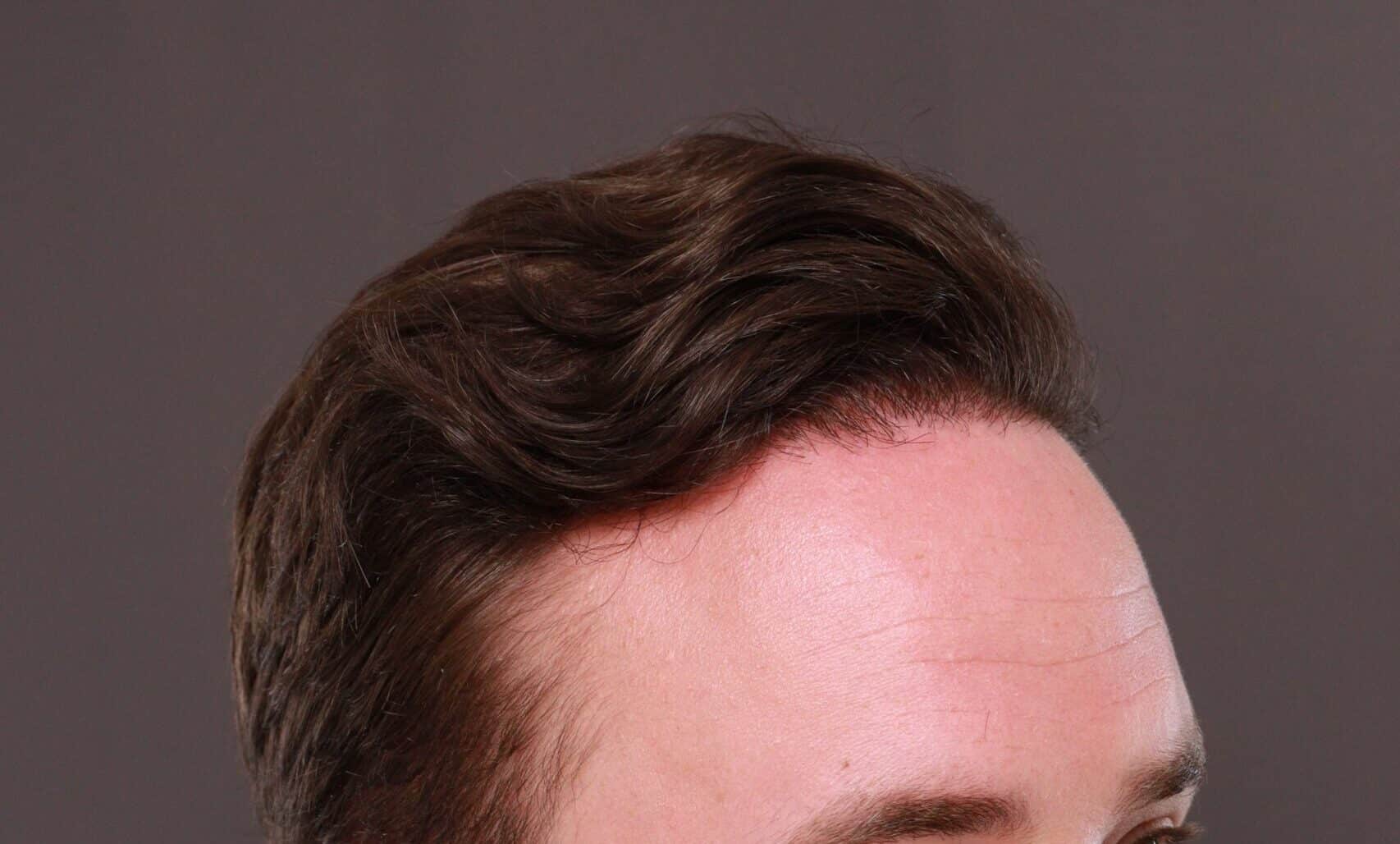 After Image: FUE Hair Transplant by Dr. Thompson - right-front-oblique