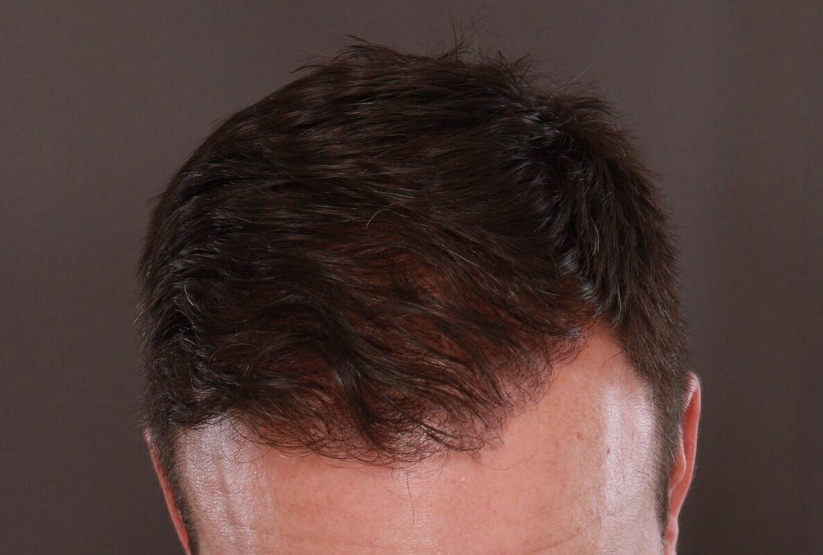 After Image: FUE Hair Transplant by Dr. Manning - front