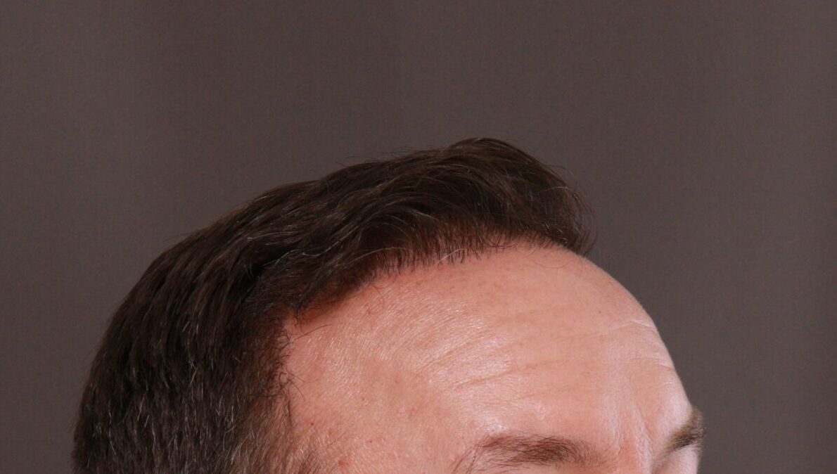 After Image: FUE Hair Transplant by Dr. Manning - right-front-oblique