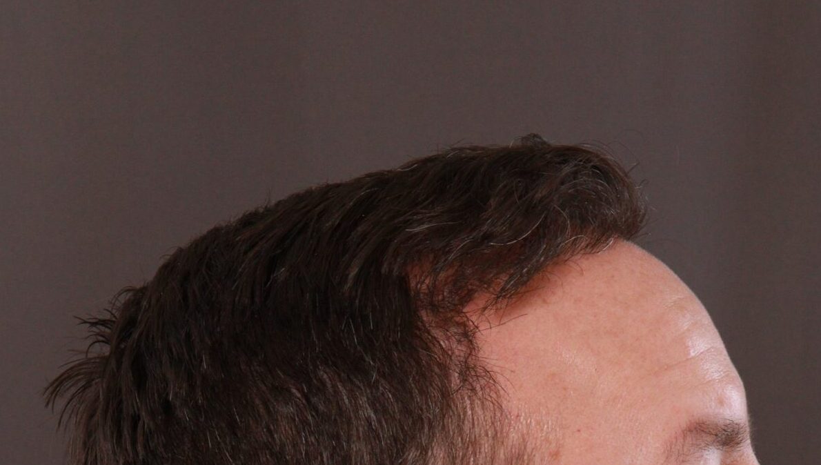After Image: FUE Hair Transplant by Dr. Manning - right-side