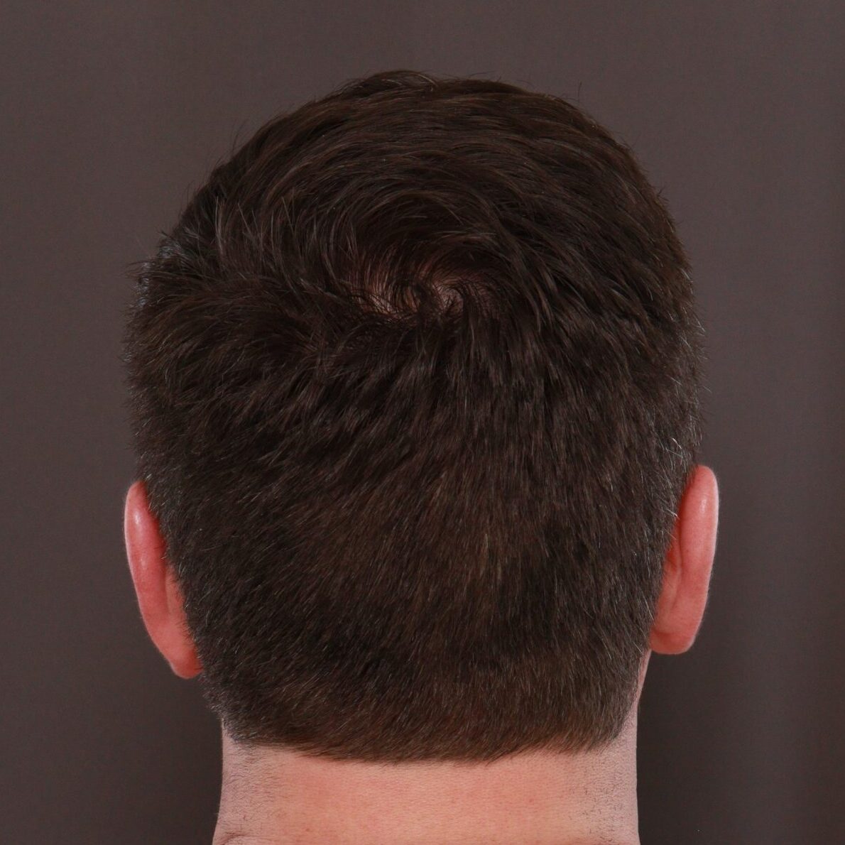 After Image: FUE Hair Transplant by Dr. Manning - back