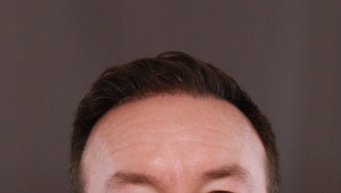 After Image: FUE Hair Transplant by Dr. Manning - front