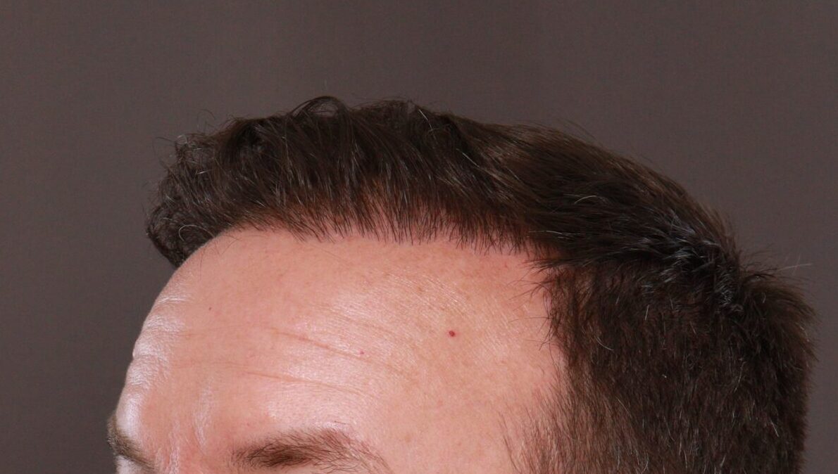 After Image: FUE Hair Transplant by Dr. Manning - left-front-oblique