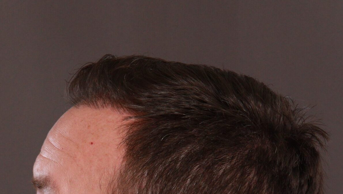 After Image: FUE Hair Transplant by Dr. Manning - left-side