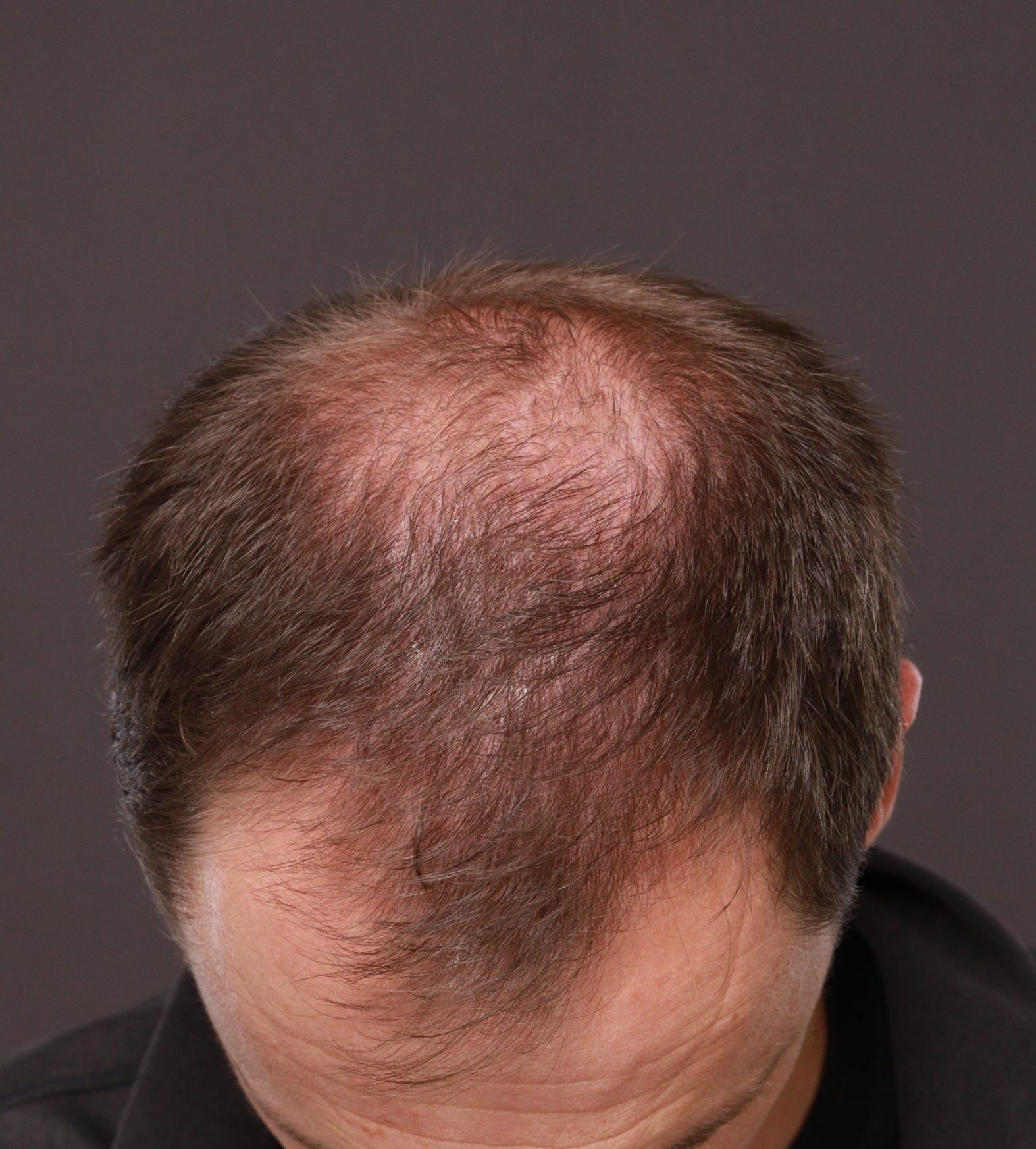 Before Image: FUT Hair Transplant by Dr. Thompson - front
