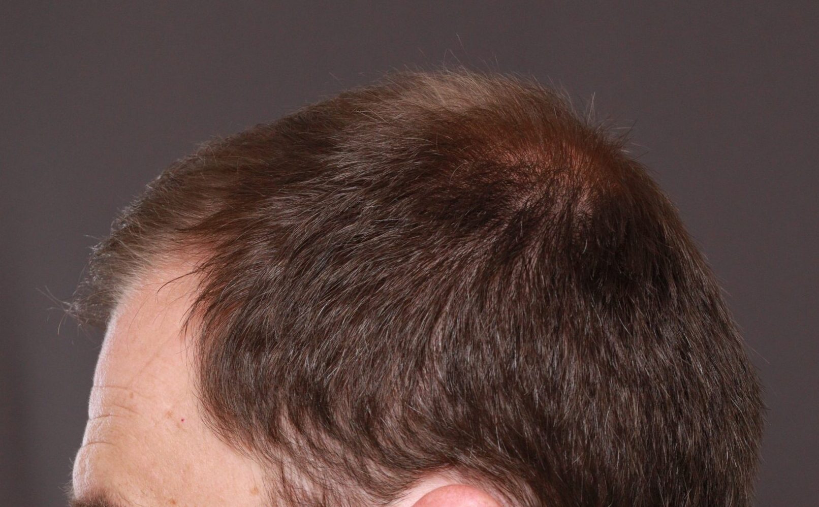 Before Image: FUT Hair Transplant by Dr. Thompson - left-side