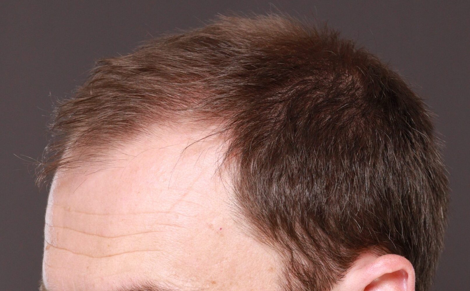Before Image: FUT Hair Transplant by Dr. Thompson - left-front-oblique
