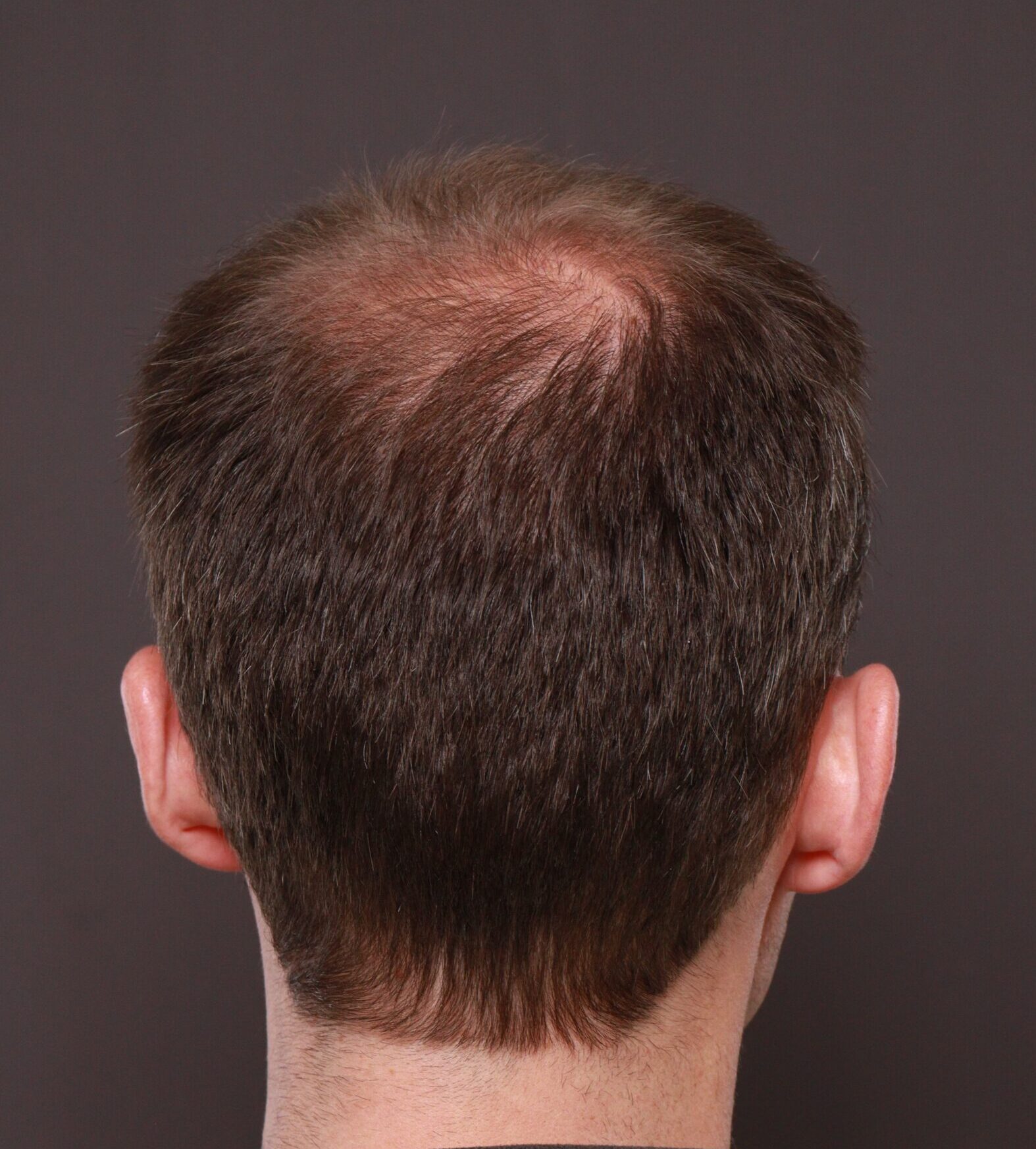 Before Image: FUT Hair Transplant by Dr. Thompson - back