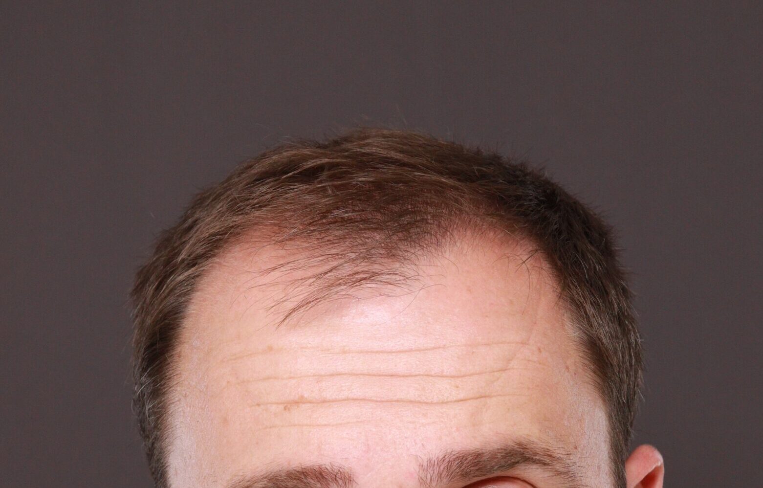 Before Image: FUT Hair Transplant by Dr. Thompson - front