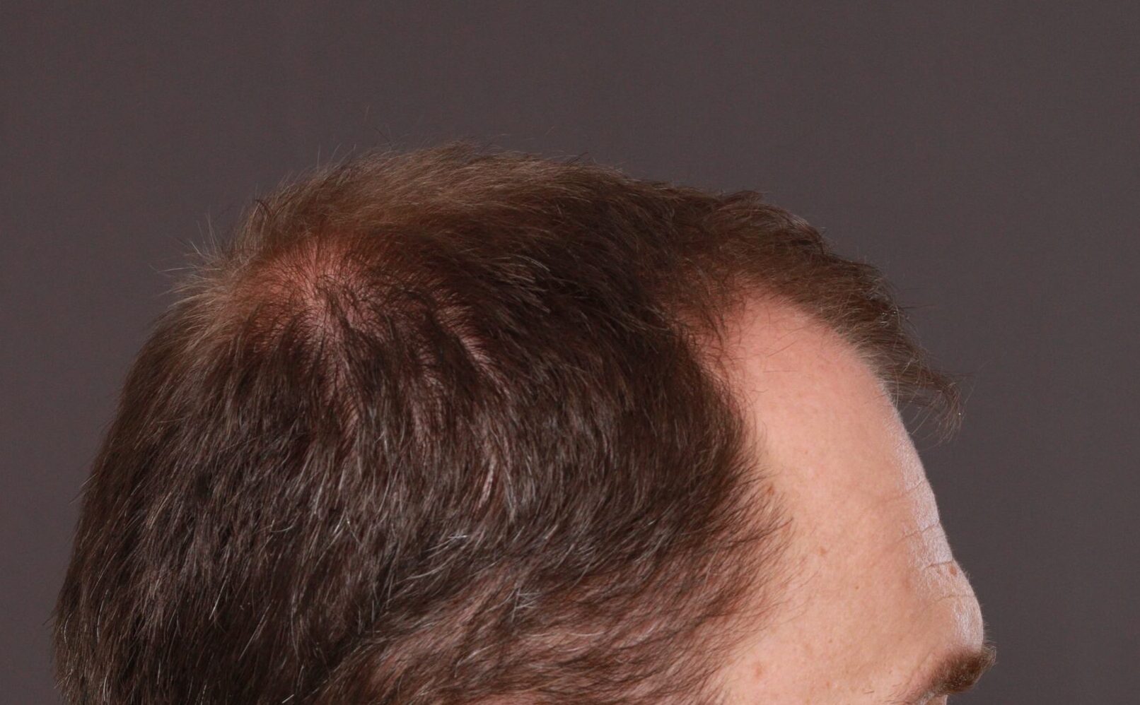 Before Image: FUT Hair Transplant by Dr. Thompson - right-side