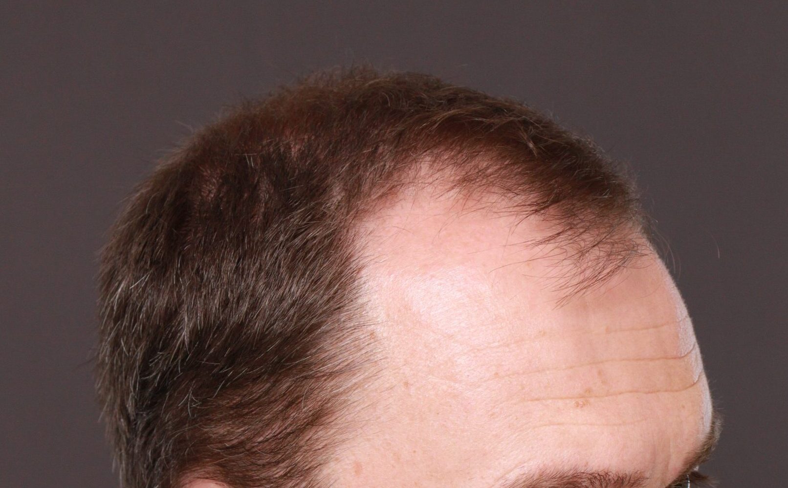 Before Image: FUT Hair Transplant by Dr. Thompson - right-front-oblique