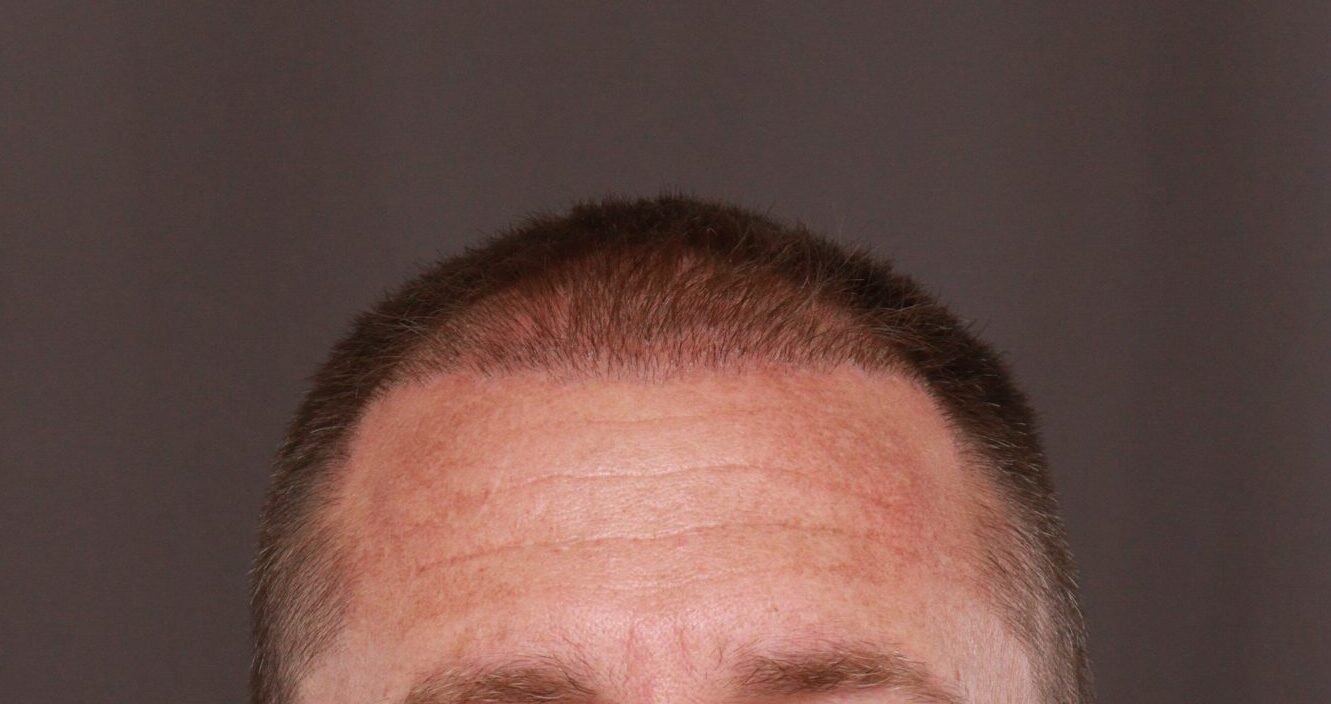 Before Image: FUE Hair Transplant by Dr. Manning - front