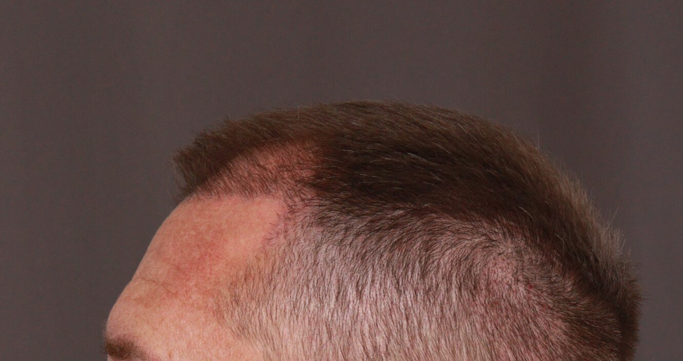 Before Image: FUE Hair Transplant by Dr. Manning - left-side