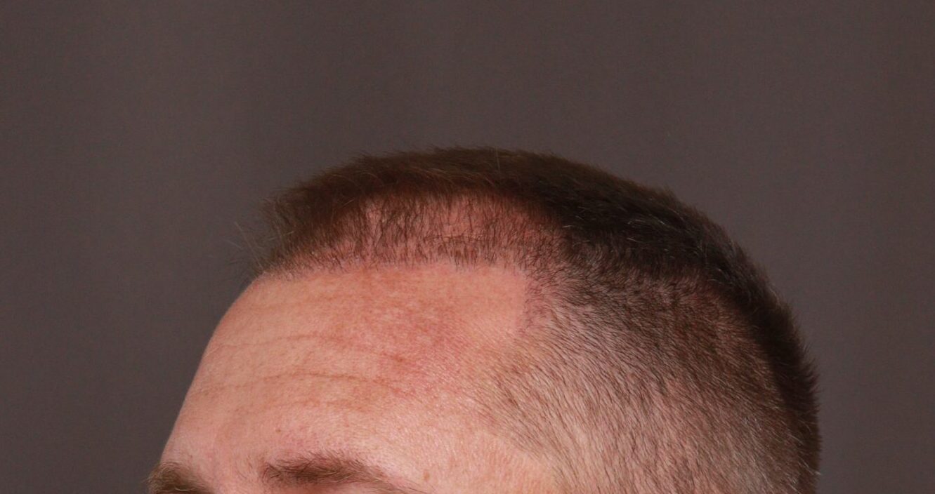 Before Image: FUE Hair Transplant by Dr. Manning - left-front-oblique