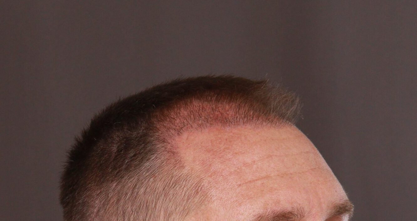 Before Image: FUE Hair Transplant by Dr. Manning - right-front-oblique