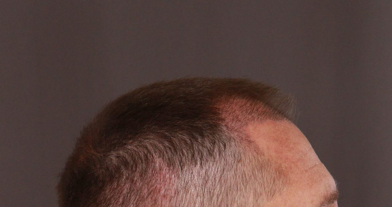 Before Image: FUE Hair Transplant by Dr. Manning - front