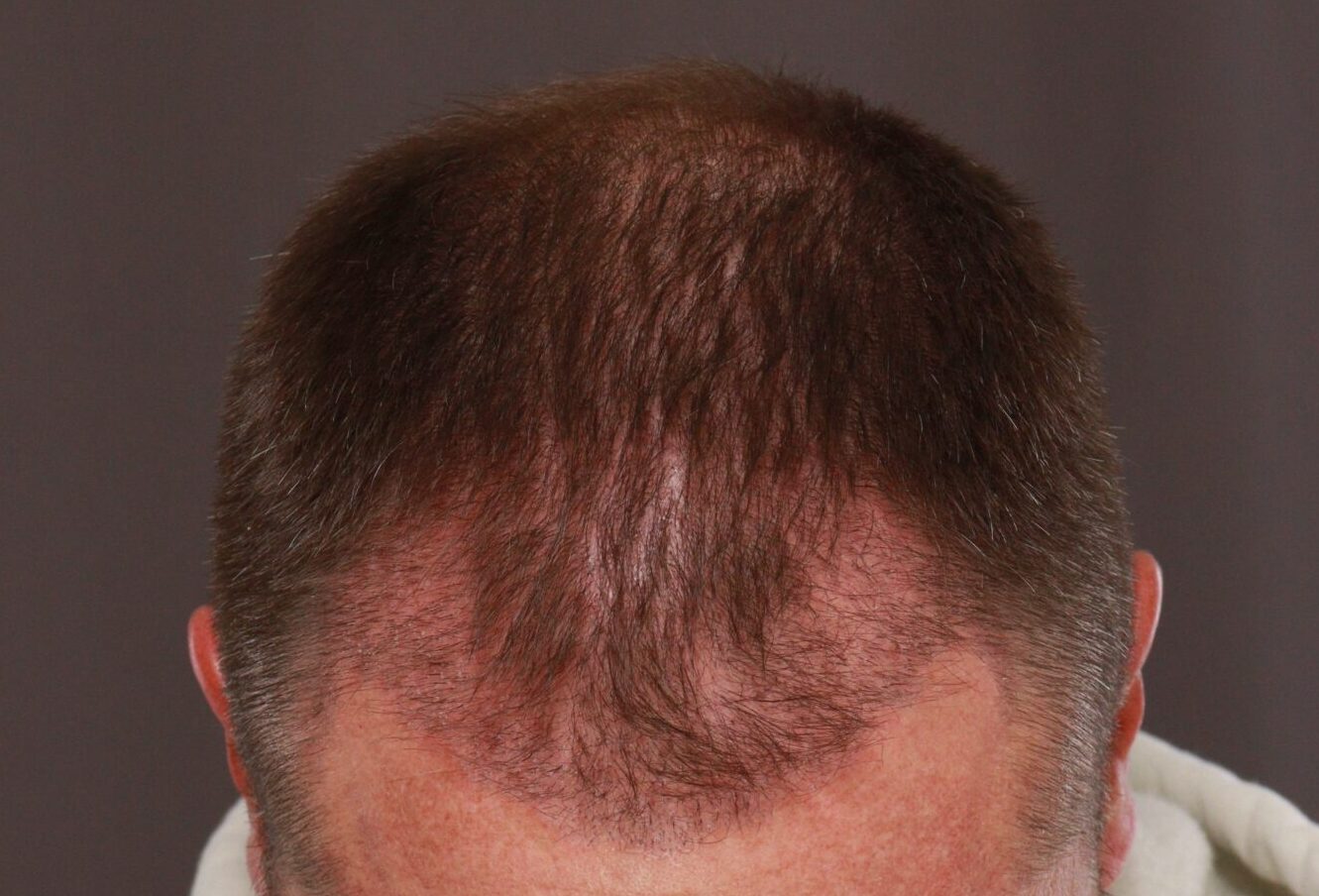 Before Image: FUE Hair Transplant by Dr. Manning - front