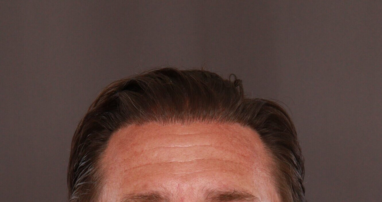 After Image: FUE Hair Transplant by Dr. Manning - front