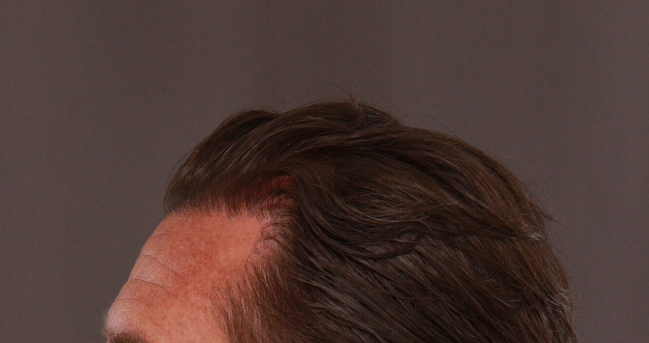 After Image: FUE Hair Transplant by Dr. Manning - left-side