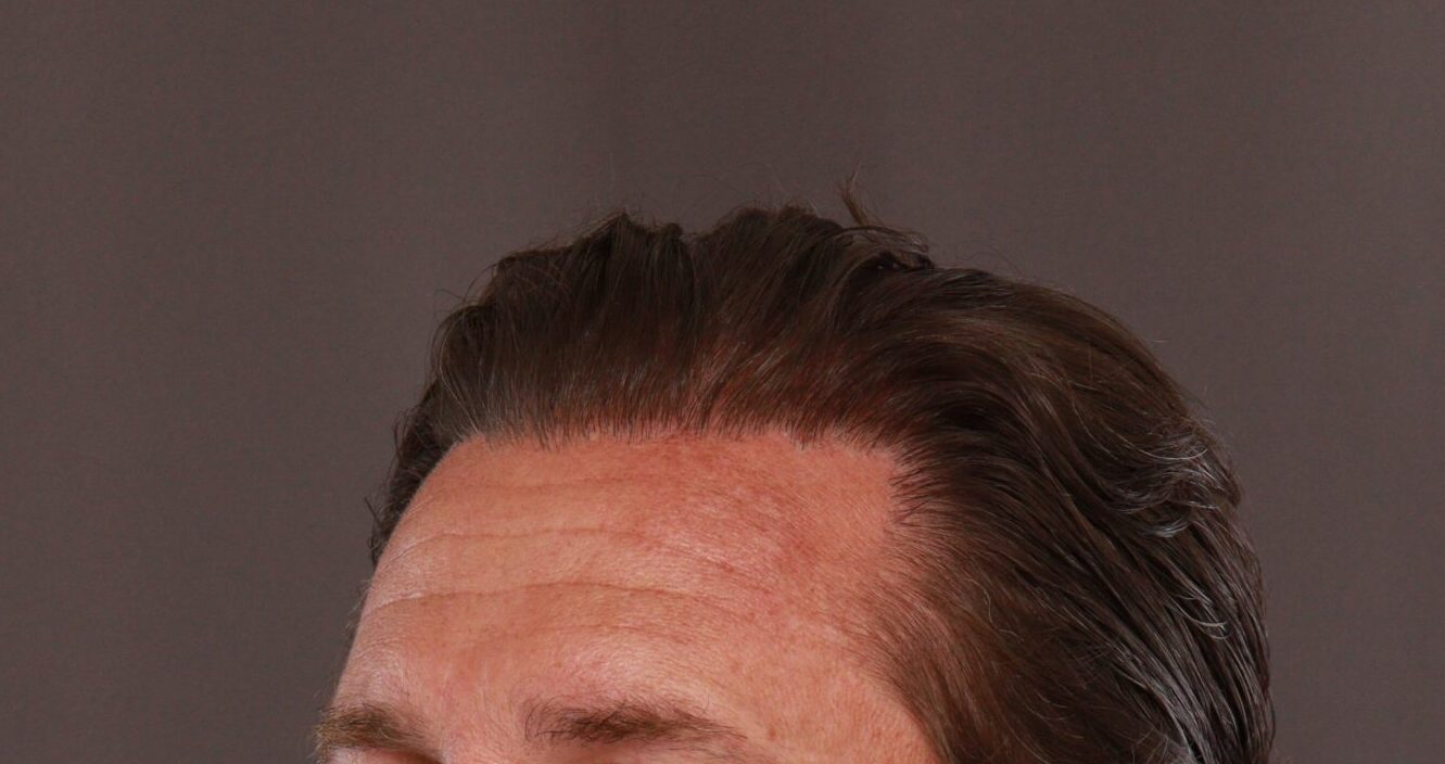 After Image: FUE Hair Transplant by Dr. Manning - left-front-oblique