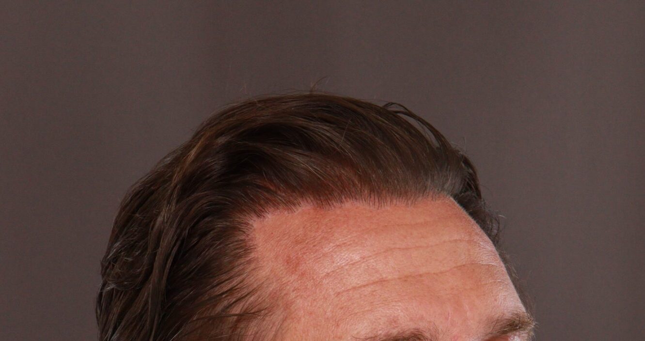 After Image: FUE Hair Transplant by Dr. Manning - right-front-oblique