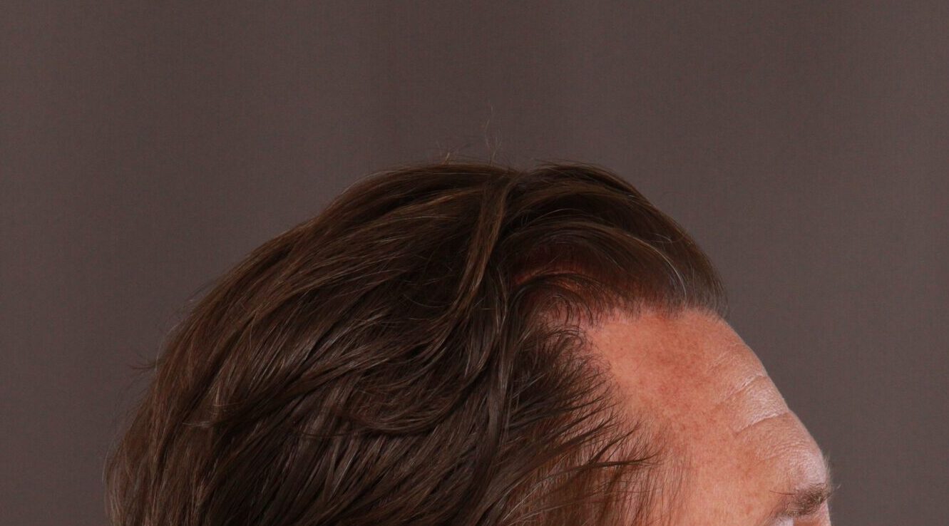 After Image: FUE Hair Transplant by Dr. Manning - front