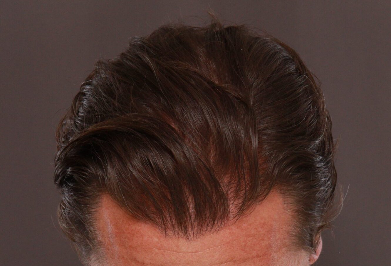 After Image: FUE Hair Transplant by Dr. Manning - front