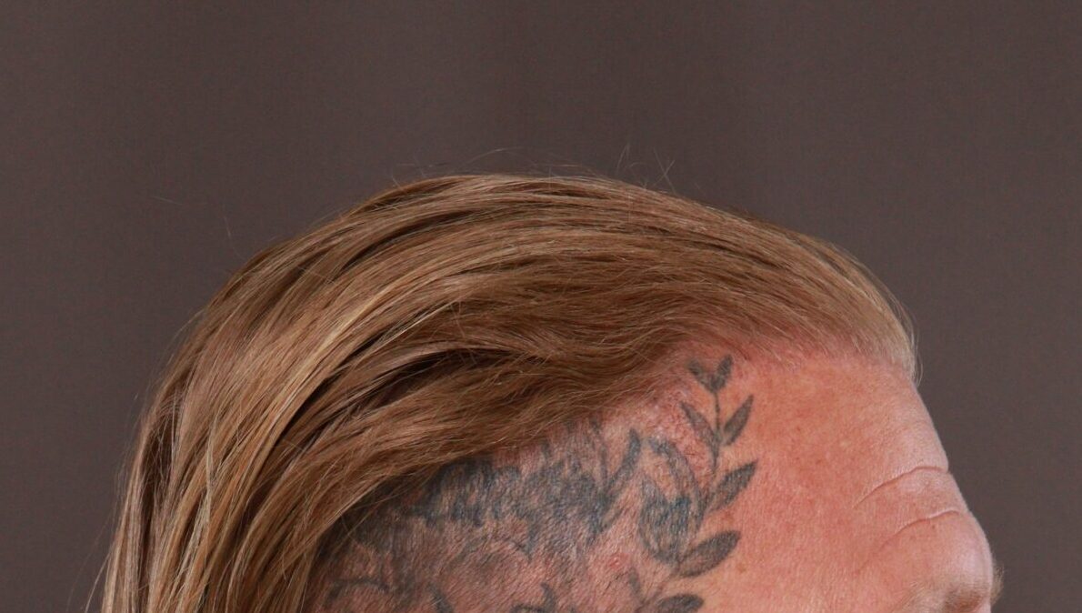 After Image: FUT Hair Transplant by Dr. Manning - right-side